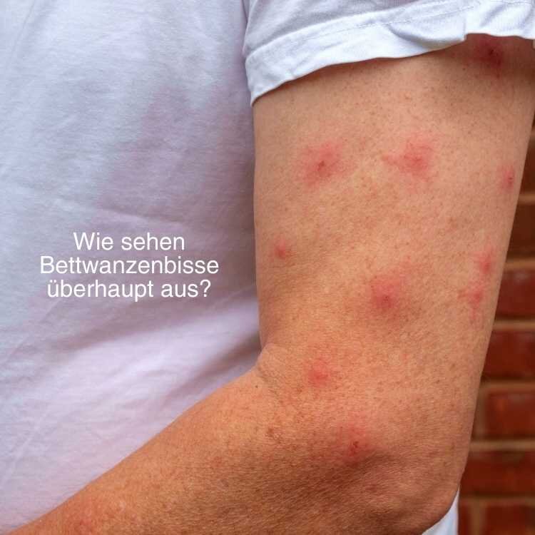Bettwanzenbisse